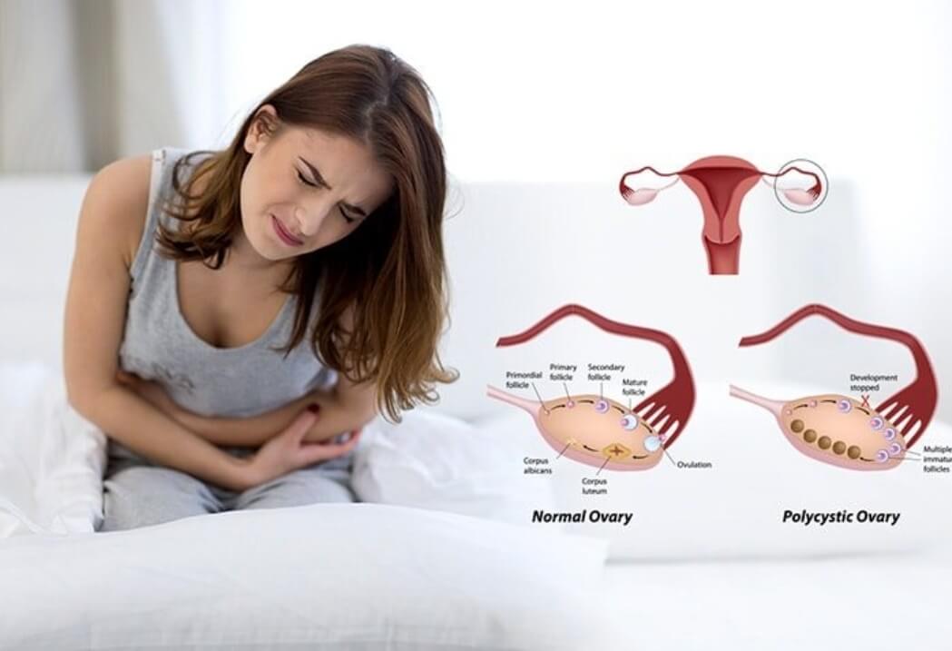 Mengenal Sindrom Ovarium Polikistik (PCOS), Wanita wajib Tau !