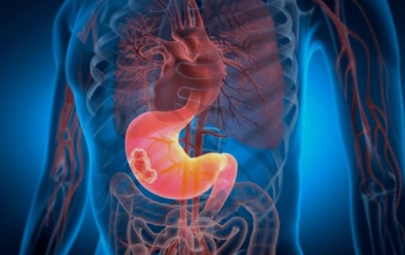 Sering Dikira Maag, Ternyata Bisa Jadi Kanker Lambung