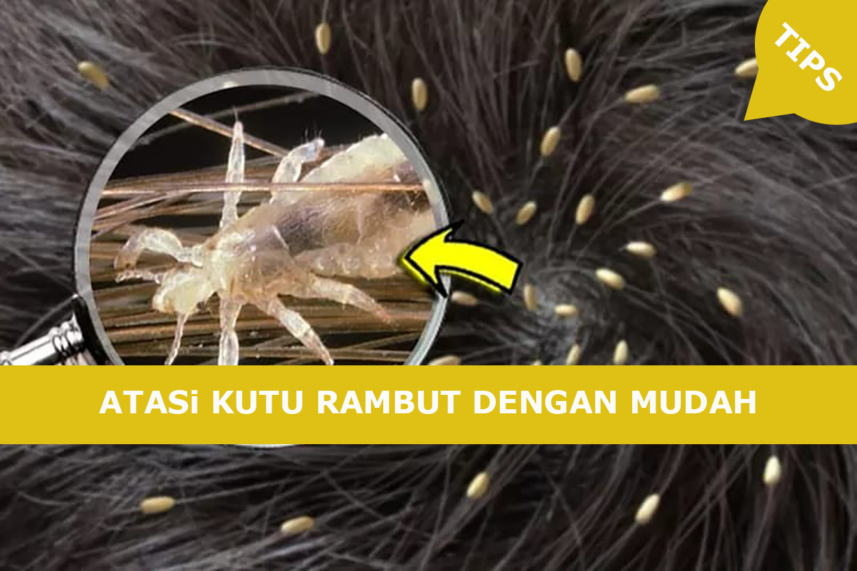 MUDAH SEKALI! Basmi Kutu Rambut sampai ke Telurnya, Hanya Pakai Bahan Dapur saja?