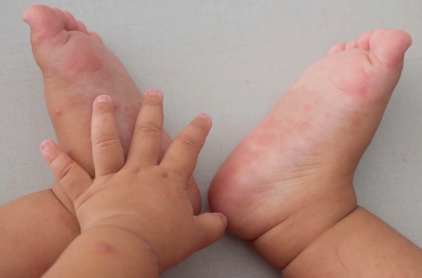 Jangan Anggap Sepele, Ini Ciri-Ciri Flu Singapura pada Anak