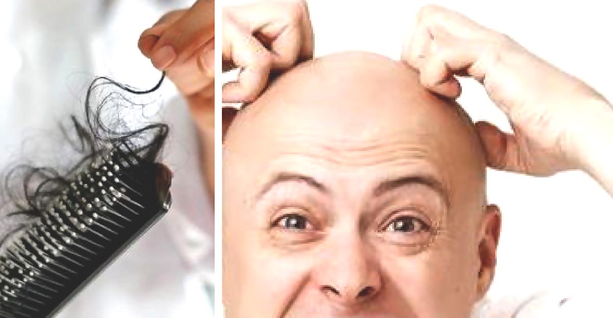 Kerontokan Rambut atau Botak Dini Pada Usia Remaja, Benarkah Akibat Terlalu Banyak Berpikir dan Sakit Kanker