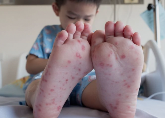 Jangan Anggap Sepele! Ini 5 Cara Lindungi Anak dari Flu Singapura