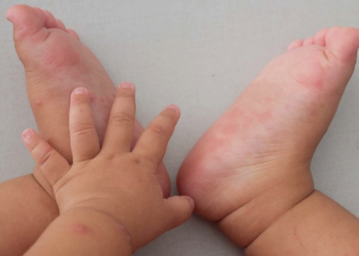 Jangan Anggap Sepele, Ini Ciri-Ciri Flu Singapura pada Anak