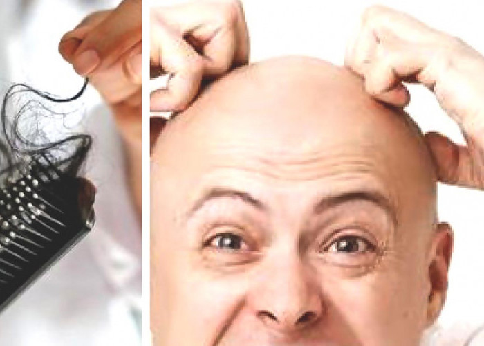 Kerontokan Rambut atau Botak Dini Pada Usia Remaja, Benarkah Akibat Terlalu Banyak Berpikir dan Sakit Kanker