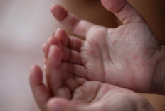 Kenali Flu Singapura Sejak Dini Agar Tidak Menular ke Anak Lain