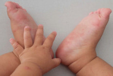 Jangan Anggap Sepele, Ini Ciri-Ciri Flu Singapura pada Anak